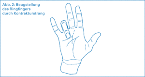 Schemazeichnung der Beugstellung des Ringfingers durch den Kontrakturstrang bei einer Dupuytren-Kontraktur