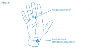 Schemazeichnung zur Erklärung von Ganglien wie Ringbandganglion und beugseitiges Handgelenkganglions