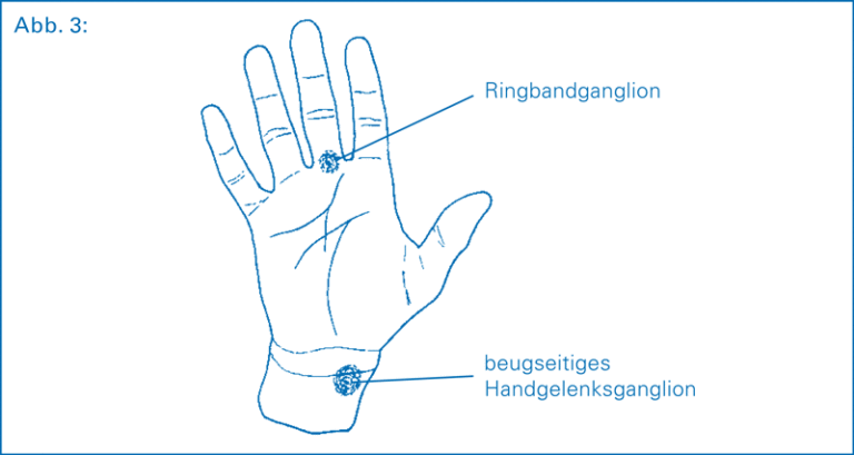 Ganglion Freiburg, BadenWürttemberg Chirurgie im Stühlinger