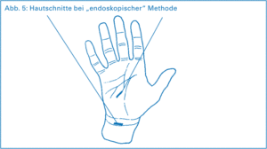 Schemazeichnung einer Hand zur Veranschaulicher der Hautschnitter bei 'endoskopischer Methode' zur Behandlung vom Karpaltunnelsyndrom