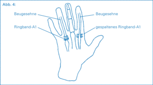Schemazeichnung von Sehnen in der Hand zur Erklärung eines Schnappfingers