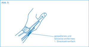 Schema Zeichnung einer Tendovaginitis de Quervain, welche Schmerzen im Handgelenk verursacht